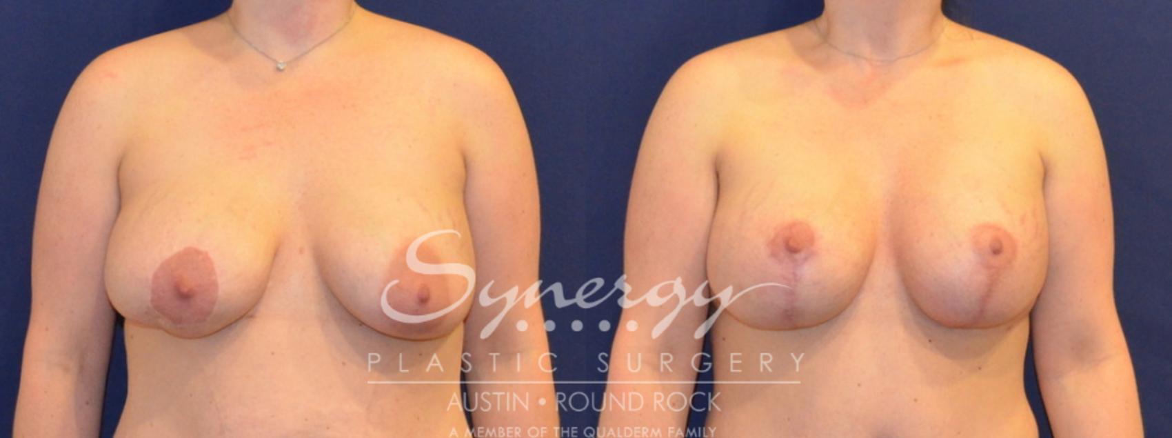 Before & After Reconstruction - Congenital Breast Case 394 View #1 View in Round Rock, TX