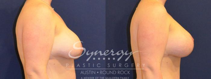 Before & After Reconstruction - Congenital Breast Case 394 View #2 View in Austin, TX