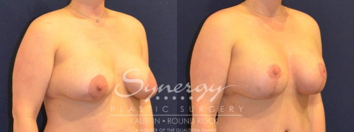 Before & After Reconstruction - Congenital Breast Case 394 View #3 View in Austin, TX