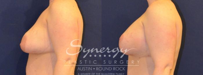 Before & After Reconstruction - Congenital Breast Case 394 View #4 View in Austin, TX