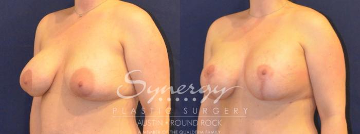 Before & After Reconstruction - Congenital Breast Case 394 View #5 View in Austin, TX