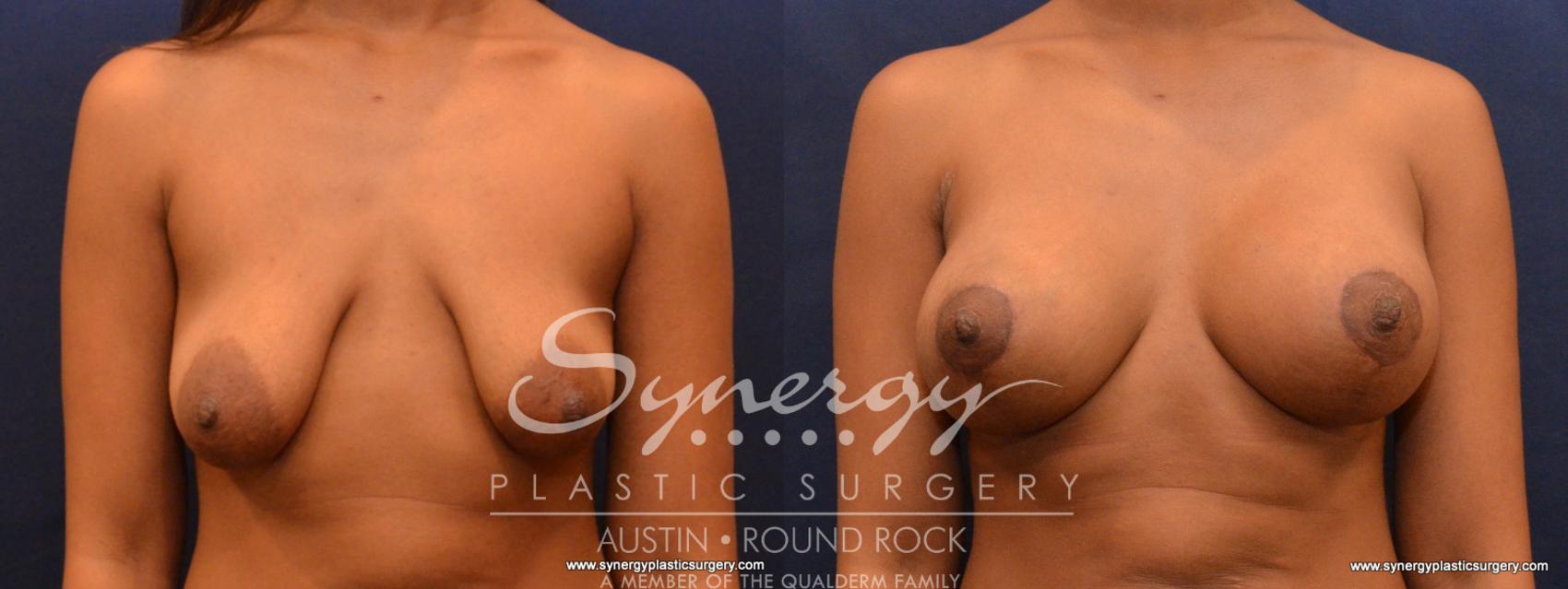 Before & After Reconstruction - Congenital Breast Case 568 View #1 View in Round Rock, TX