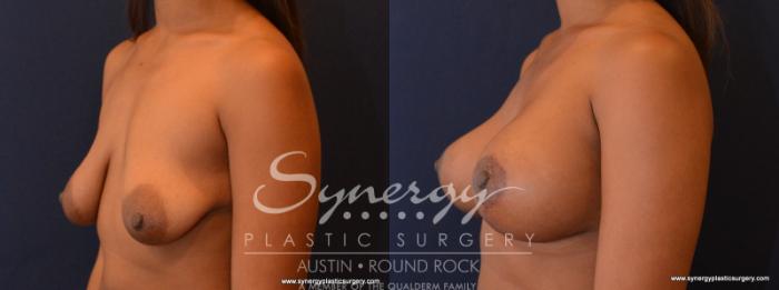 Before & After Reconstruction - Congenital Breast Case 568 View #2 View in Austin, TX