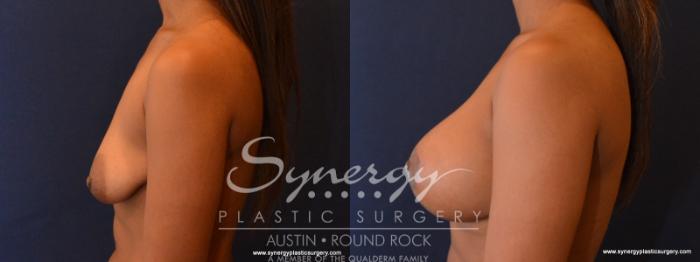 Before & After Reconstruction - Congenital Breast Case 568 View #3 View in Austin, TX