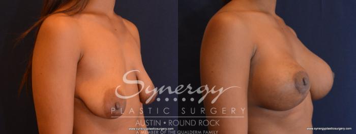 Before & After Reconstruction - Congenital Breast Case 568 View #4 View in Austin, TX
