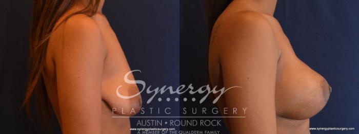 Before & After Reconstruction - Congenital Breast Case 568 View #5 View in Austin, TX