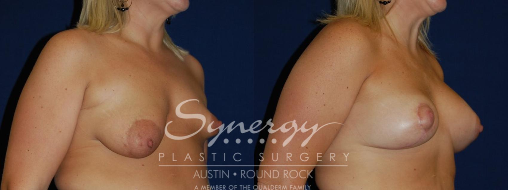 Before & After Reconstruction - Congenital Breast Case 91 View #1 View in Round Rock, TX