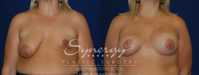 Before & After Reconstruction - Congenital Breast Case 91 View #2 View in Austin, TX