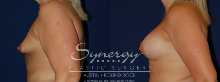 Before & After Reconstruction - Congenital Breast Case 91 View #3 View in Austin, TX