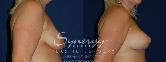 Before & After Reconstruction - Congenital Breast Case 91 View #4 View in Austin, TX