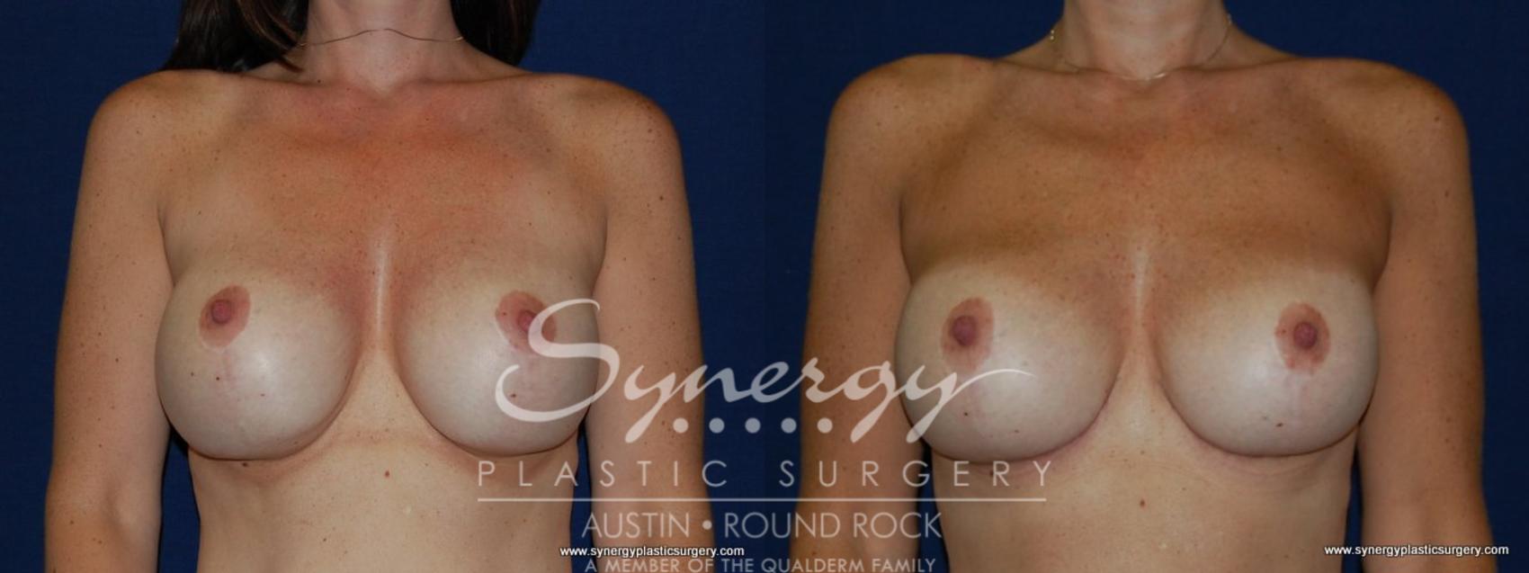 Before & After Revision Breast Augmentation Case 144 View #1 View in Austin, TX