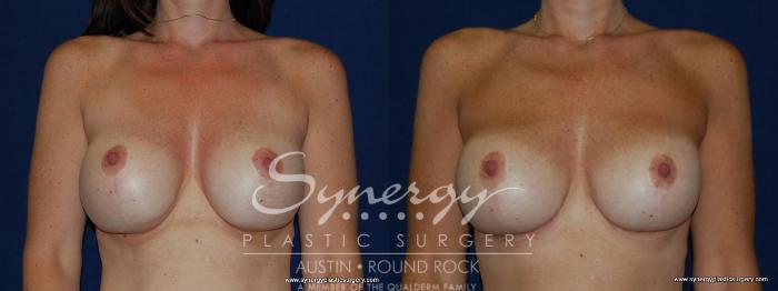Before & After Revision Breast Augmentation Case 144 View #1 View in Austin, TX