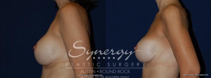 Before & After Revision Breast Augmentation Case 144 View #2 View in Austin, TX