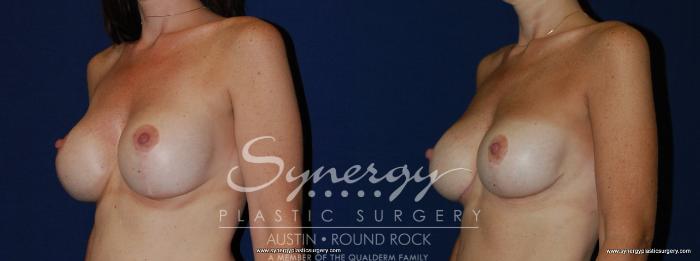 Before & After Revision Breast Augmentation Case 144 View #3 View in Austin, TX