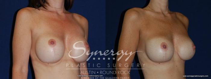 Before & After Revision Breast Augmentation Case 144 View #4 View in Austin, TX