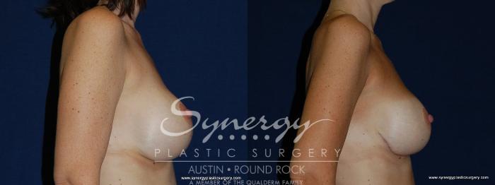 Before & After Revision Breast Augmentation Case 144 View #5 View in Austin, TX