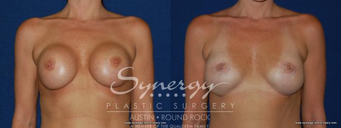 Before & After Revision Breast Augmentation Case 147 View #1 View in Austin, TX