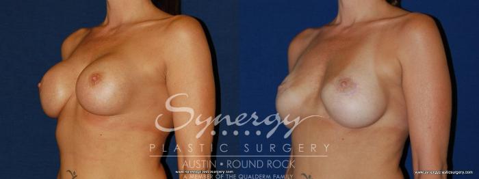 Before & After Revision Breast Augmentation Case 147 View #2 View in Austin, TX