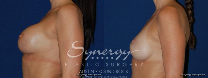 Before & After Revision Breast Augmentation Case 147 View #3 View in Austin, TX