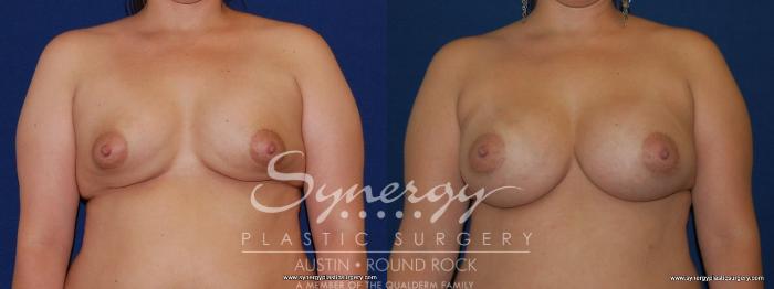 Before & After Revision Breast Augmentation Case 168 View #1 View in Austin, TX