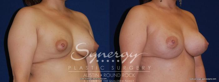 Before & After Revision Breast Augmentation Case 168 View #2 View in Austin, TX