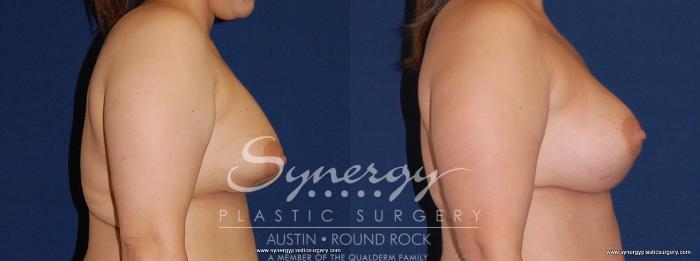 Before & After Revision Breast Augmentation Case 168 View #3 View in Austin, TX