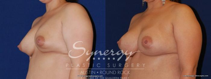 Before & After Revision Breast Augmentation Case 168 View #4 View in Austin, TX