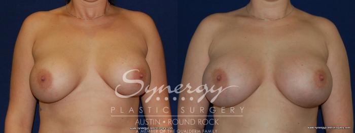 Before & After Revision Breast Augmentation Case 189 View #1 View in Austin, TX