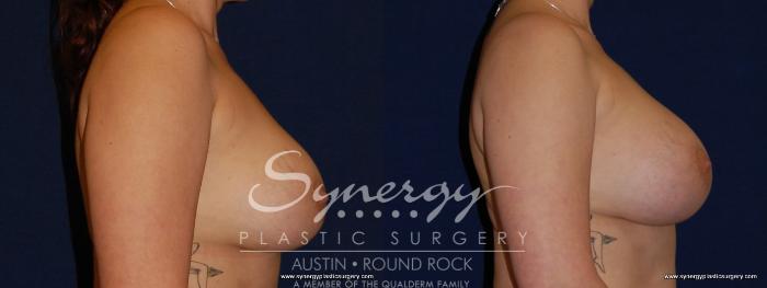 Before & After Revision Breast Augmentation Case 189 View #2 View in Austin, TX