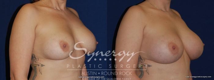 Before & After Revision Breast Augmentation Case 189 View #4 View in Austin, TX