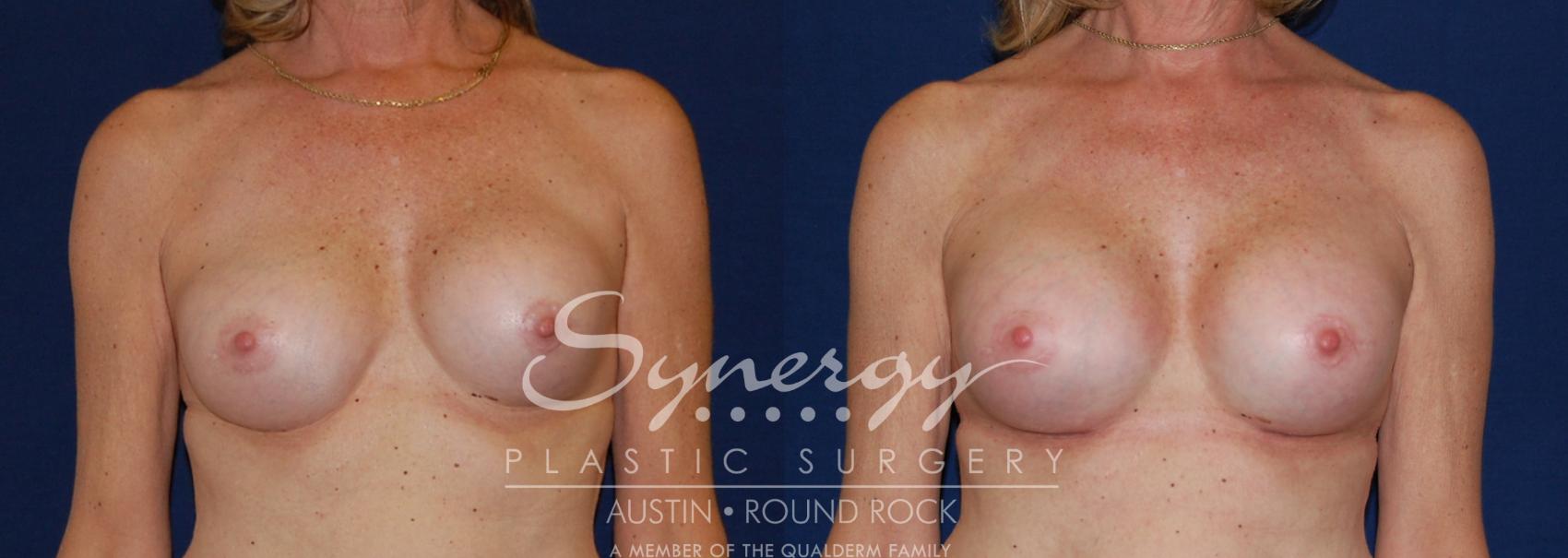 Before & After Revision Breast Augmentation Case 198 View #1 View in Austin, TX