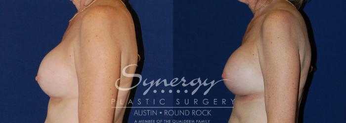 Before & After Revision Breast Augmentation Case 198 View #2 View in Austin, TX