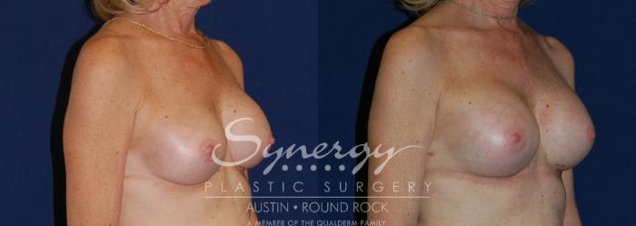 Before & After Revision Breast Augmentation Case 198 View #3 View in Austin, TX