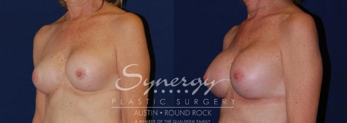 Before & After Revision Breast Augmentation Case 198 View #4 View in Austin, TX