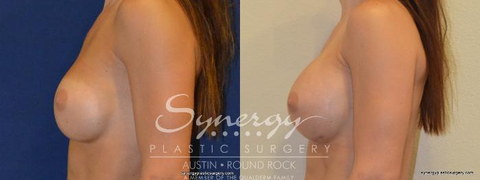 Before & After Revision Breast Augmentation Case 234 View #2 View in Austin, TX