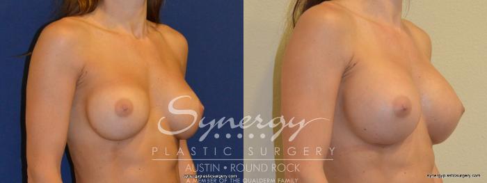 Before & After Revision Breast Augmentation Case 234 View #3 View in Austin, TX
