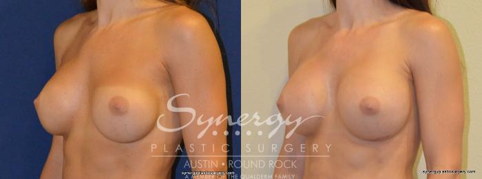 Before & After Revision Breast Augmentation Case 234 View #4 View in Austin, TX
