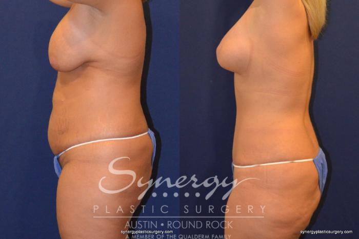 Before & After Revision Breast Augmentation Case 242 View #2 View in Austin, TX