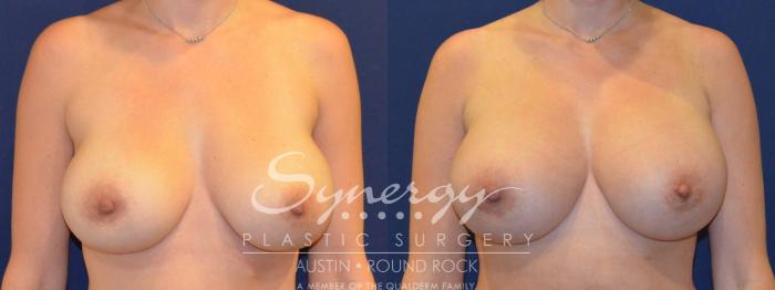 Before & After Revision Breast Augmentation Case 286 View #1 View in Austin, TX