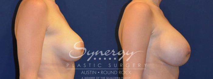 Before & After Revision Breast Augmentation Case 286 View #2 View in Austin, TX