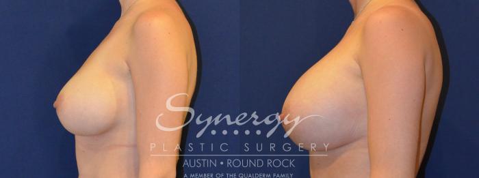 Before & After Revision Breast Augmentation Case 286 View #3 View in Austin, TX