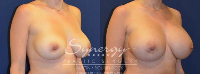Before & After Revision Breast Augmentation Case 286 View #4 View in Austin, TX