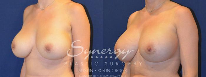 Before & After Revision Breast Augmentation Case 286 View #5 View in Austin, TX