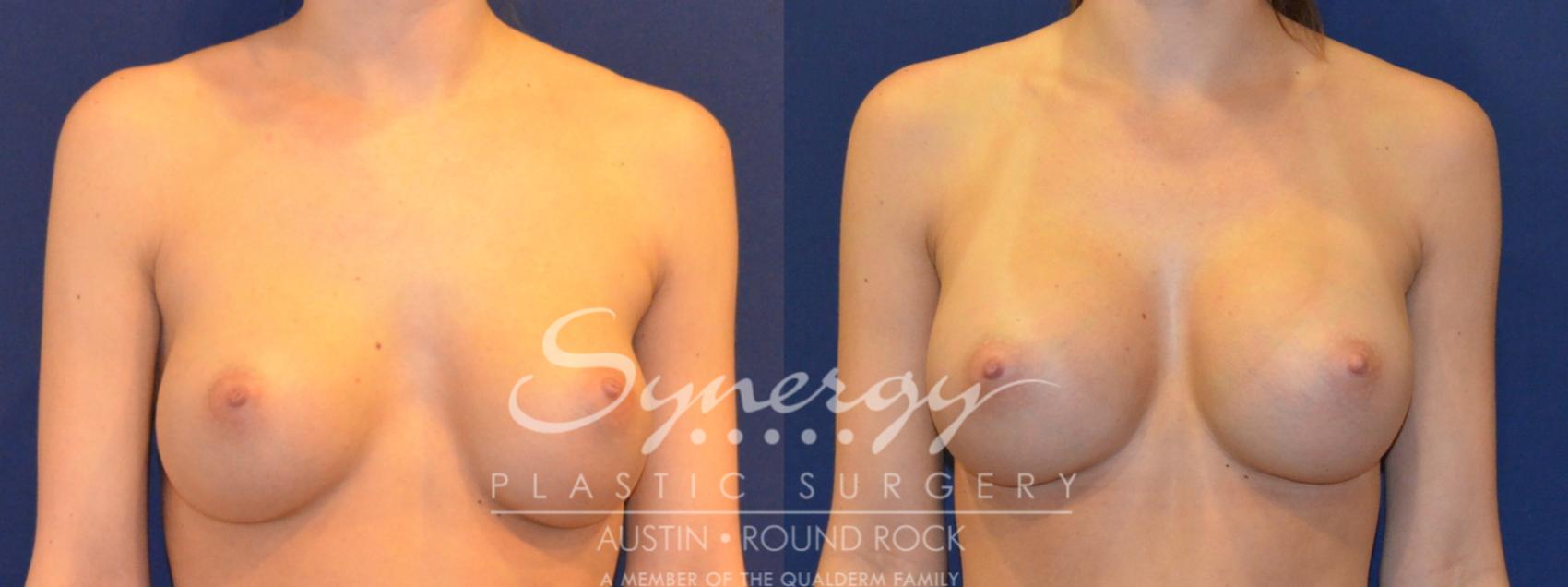 Before & After Revision Breast Augmentation Case 290 View #1 View in Austin, TX