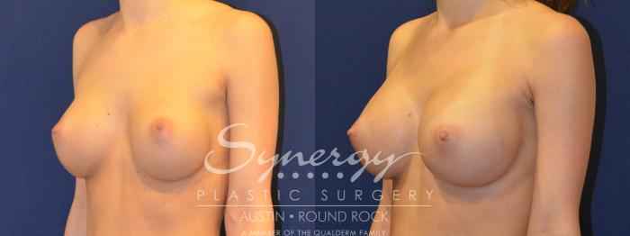 Before & After Revision Breast Augmentation Case 290 View #2 View in Austin, TX