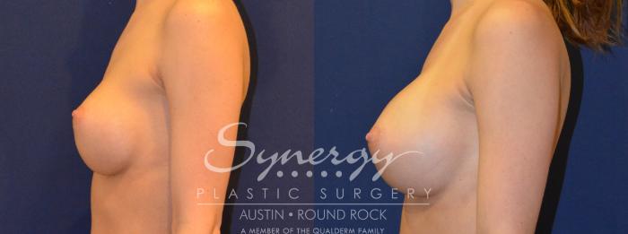 Before & After Revision Breast Augmentation Case 290 View #3 View in Austin, TX