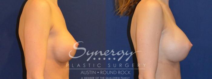 Before & After Revision Breast Augmentation Case 290 View #4 View in Austin, TX