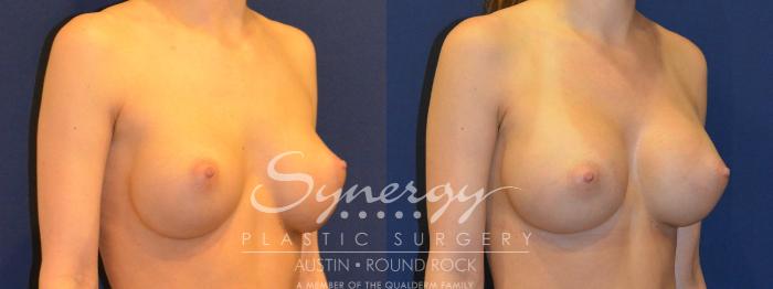Before & After Revision Breast Augmentation Case 290 View #5 View in Austin, TX