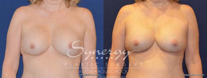 Before & After Revision Breast Augmentation Case 326 View #1 View in Austin, TX