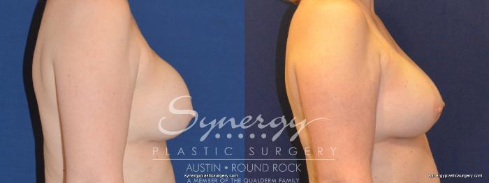 Before & After Revision Breast Augmentation Case 326 View #2 View in Austin, TX